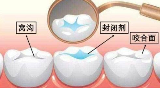 窝沟封闭适用于所有人吗？做窝沟封闭多少钱