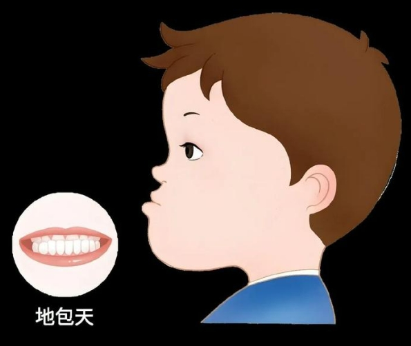 儿童地包天怎么办？如何矫正