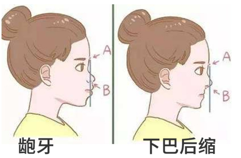 青少年下颌不齐有哪些好办法？
