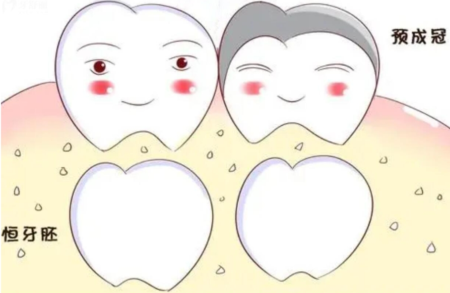 儿童预成冠能起到什么作用，需要多少钱？