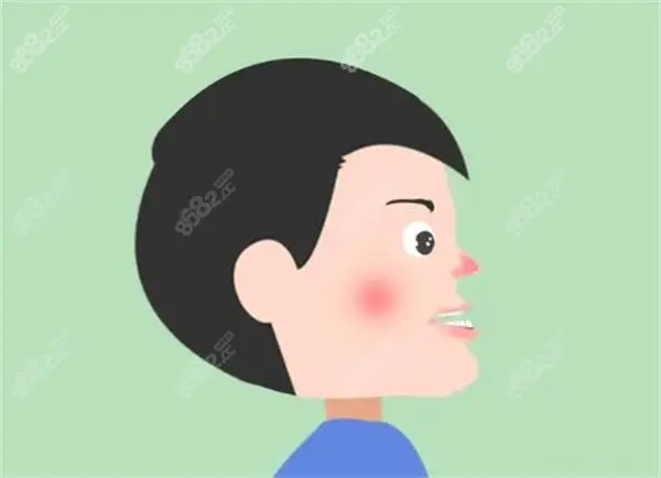 地包天：什么时间去矫治合适？