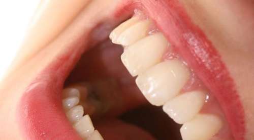 门牙稀是矫正好还是贴面好？各自优劣势是什么？