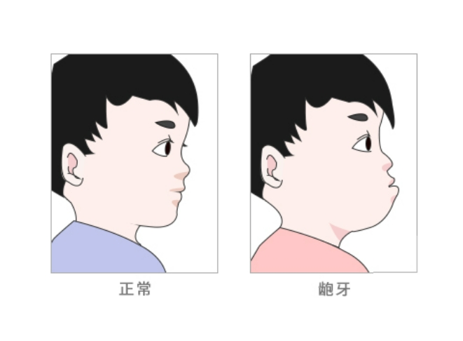 做完牙齿贴面后，会不会脱落？