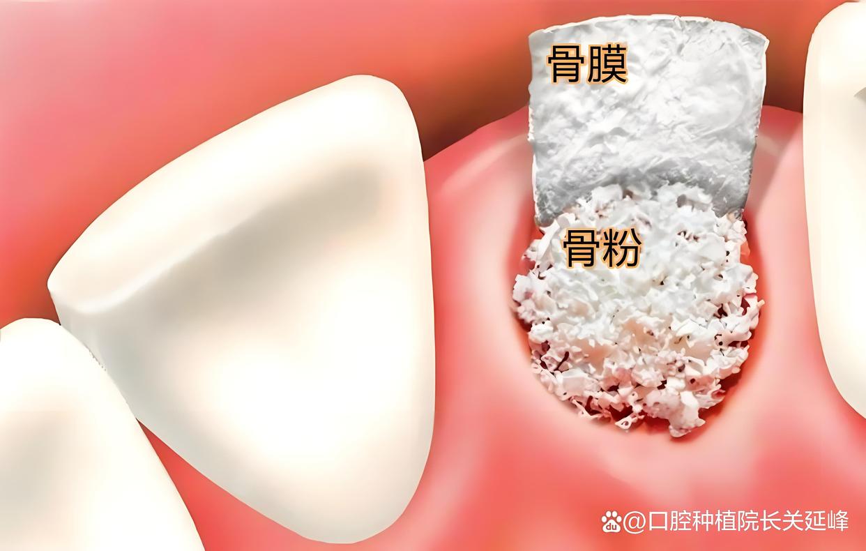 什么情况下做种植牙，需要先植骨？