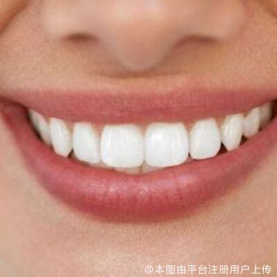 牙贴面会不会变黄？牙贴面会损害牙齿吗？