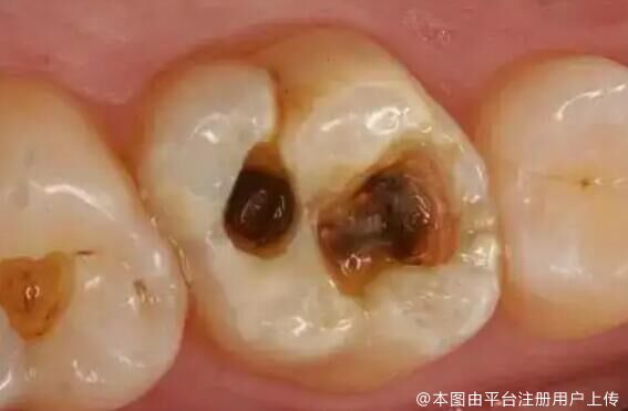 蛀牙不疼，为何仍需修补？