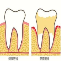 牙龈萎缩的症状有哪些？