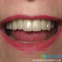 种植牙什么样的人群适合做？需要多长时间？