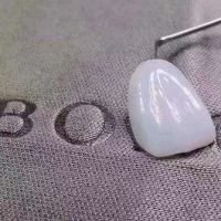 牙齿贴面怎么取下来？注意事项有哪几方面？
