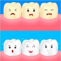 牙齿贴面是什么样的？牙齿贴面的种类有哪些？