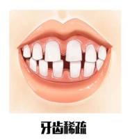 成人门牙牙缝大可以补救吗?补救方法有哪些？