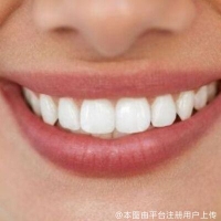 牙贴面会不会变黄？牙贴面会损害牙齿吗？