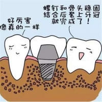满口种植牙需要投入多少钱？