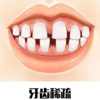 牙缝过大的调节方法有哪些？费用是多少？