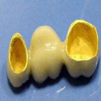 什么是黄金烤瓷牙？优点有哪些？