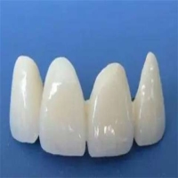 钴铬金属烤瓷牙：美观耐用的牙齿修复选择