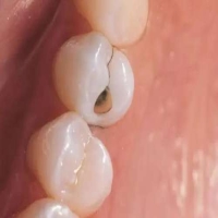 虫牙有个洞怎么处理好？常见方法有哪几种？