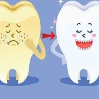 牙齿贴面能保持几年？延长贴面的使用寿命有哪些方法？