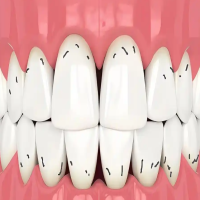 牙齿上的小黑点是怎么回事？怎样预防？