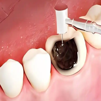 不痛的牙洞也需要补吗？