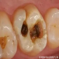 蛀牙不疼，为何仍需修补？
