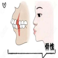 儿童骨性龅牙做正畸的最佳时间是几岁？