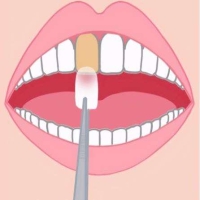 牙齿有缝隙用贴面好不好？是否适合进行贴面修复呢？