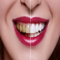 牙齿发黄如何变白？简单的方法有哪些？