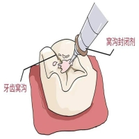 窝沟封闭治疗后,还会继续腐蚀牙齿吗？