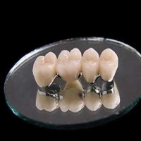 烤瓷牙的具体价格是多少？受哪些因素影响？