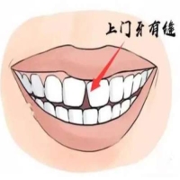 成人牙齿缝隙大怎么办？矫正方法和注意事项详解！
