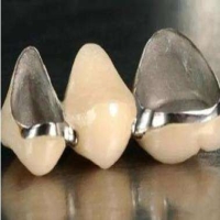 什么是钯银合金烤瓷牙?调节方法分享！