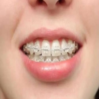 上龅牙怎么矫正好？矫正龅牙的方法有哪些？