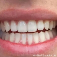 什么情况下要做根管治疗？