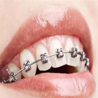 牙齿矫正器是什么？需要一直戴吗？
