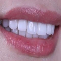 贴片牙齿优越性主要体现在哪些方面？