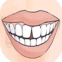 门牙缝隙黑了一点点，有必要补牙吗?