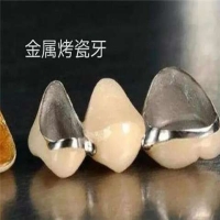 烤瓷牙和绷瓷是一样的吗？怎么区分？