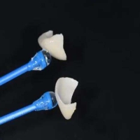 瓷牙贴面的价格是多少?受哪些因素影响？