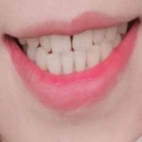 牙周刮治的费用是多少？