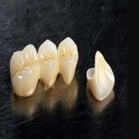 门牙有缝能做瓷贴面吗？手术流程是什么？