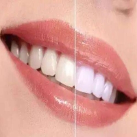 补过的牙能否进行冷光美白？注意事项有哪些？